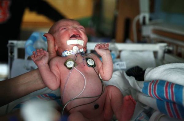 ԱՄՆ-ում երեխան առանց քթի է ծնվել (լուսանկարներ)