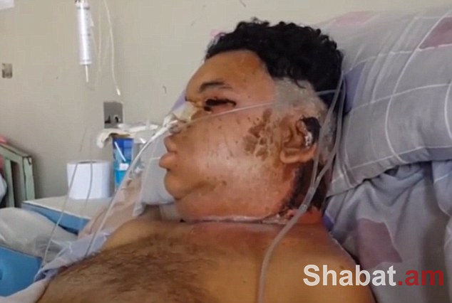 Սարդի խայթոցից հետո տղամարդը հիվանդանոցում պայքարում է մահվան դեմ (տեսանյութ, լուսանկարներ)