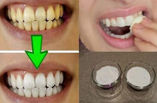 Պարզ միջոց կարճ ժամանակում դեղնած ատամները սպիտակեցնելու համար