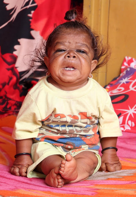 23-ամյա հնդիկ երիտասարդը 6 ամսական երեխայի տեսք ունի